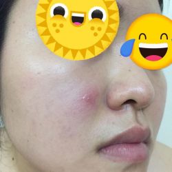 Mặt bị mụn đỏ dưới da là mụn gì?
