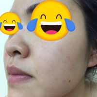 Mặt bị mụn đỏ dưới da là mụn gì?