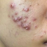 Mụn gì và cách chữa trị như thế nào? Mụn gì và cách chữa trị như thế nào?