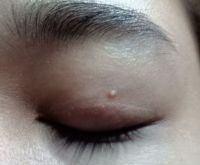 Phải làm gì với cái mụn ở gần mắt?