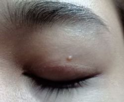 Phải làm gì với cái mụn ở gần mắt?