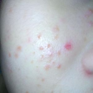 Làm gì để hết mụn ẩn, mụn li ti và mụn mủ?