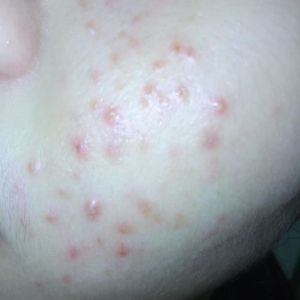 Làm gì để hết mụn ẩn, mụn li ti và mụn mủ?