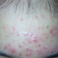 Làm gì để hết mụn ẩn, mụn li ti và mụn mủ?