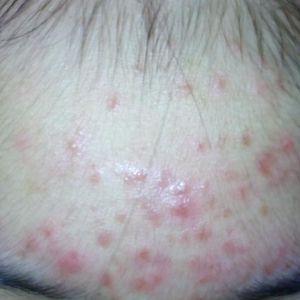 Làm gì để hết mụn ẩn, mụn li ti và mụn mủ?