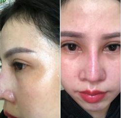 Nâng mũi 27 ngày chỗ sóng ngay mắt bị cao quá