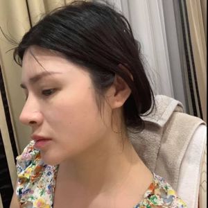 Rút sụn có tháo sụn tai ra không hay chỉ tháo sụn nhân tạo?