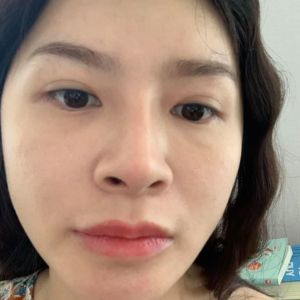 Rút sụn có tháo sụn tai ra không hay chỉ tháo sụn nhân tạo?