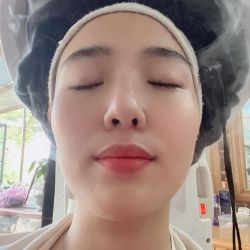 Nâng mũi bằng sụn nhân tạo lỗ mũi bị méo