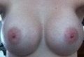 Ngực có hình dạng kỳ lạ và gò ngực kép sau khi nâng ngực