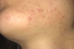 Mụn gì và cách điều trị ra sao?