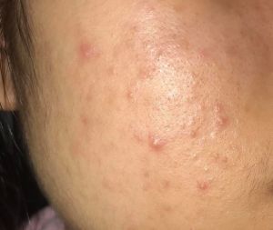 Mụn gì và cách điều trị ra sao?