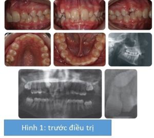Phân tích case: Niềng răng thành công cho bệnh nhân bị hô, răng nanh (R23) mọc lạc chỗ nghiêm trọng