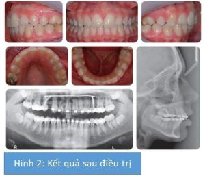 Phân tích case: Niềng răng thành công cho bệnh nhân bị hô, răng nanh (R23) mọc lạc chỗ nghiêm trọng