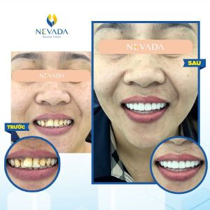 Hình ảnh bọc răng sứ của khách hàng Hoàng Kim Dung – Ca 10