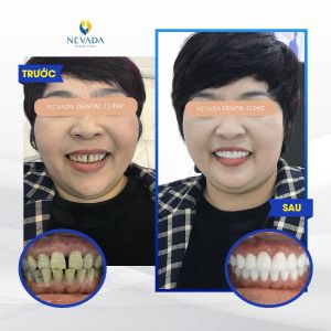 Hình ảnh bọc răng sứ của khách hàng Lê Thúy Ngà – Ca 11