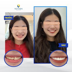 Hình ảnh bọc răng sứ của khách hàng Bùi Thanh Thảo – Ca 12