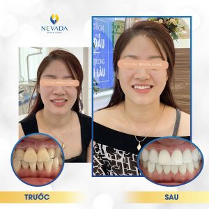 Hình ảnh bọc răng sứ của khách hàng Mai Anh – Ca 13