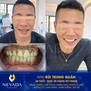Hình ảnh bọc răng sứ của khách hàng Bùi Trung Quân – Ca 14