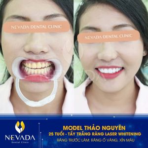 Hình ảnh tẩy trắng răng của KH Thảo Nguyên – Ca 15