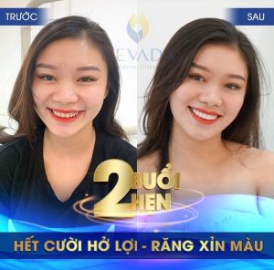 Hình ảnh dán sứ Veneer của KH Ngọc Trang – Ca 17