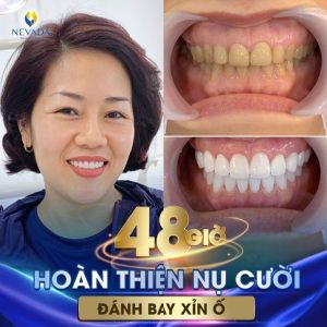 Hình ảnh bọc răng sứ của KH Trần Thị Minh Lan – Ca 19
