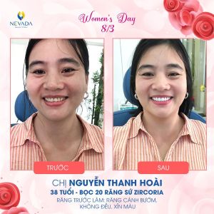 Hình ảnh bọc 20 răng sứ Zirconia của KH Nguyễn Thanh Hoài – Ca 21