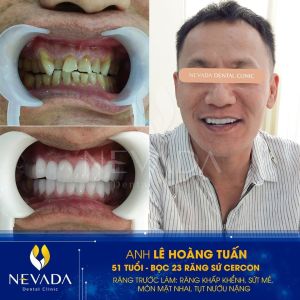 Hình ảnh bọc 23 răng sứ Cercon của KH Lê Hoàng Tuấn – Ca 22