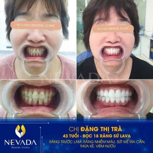 Hình ảnh bọc 18 răng sứ Lava của KH Đặng Thị Trà – Ca 23