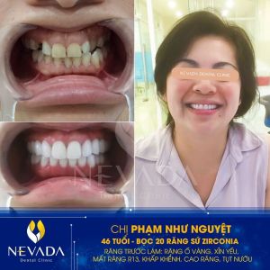 Hình ảnh bọc 20 răng sứ Zirconia của KH Phạm Như Nguyệt – Ca 24