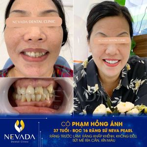 Hình ảnh bọc 16 răng sứ Neva Pearl của KH Phạm Hồng Ánh – Ca 25