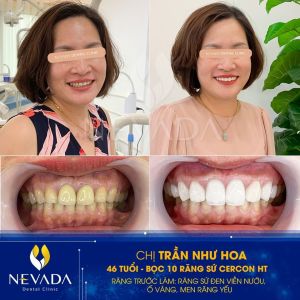 Hình ảnh bọc 10 răng sứ Cercon HT của KH Trần Như Hoa – Ca 27