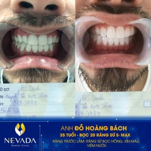 Hình ảnh bọc 20 răng sứ E-max của KH Đỗ Hoàng Bách – Ca 28