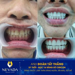 Hình ảnh bọc 16 răng sứ cercon của KH Đoàn Tất Thắng – Ca 29