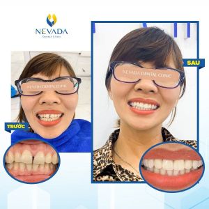 Hình ảnh bọc răng sứ của KH Vũ Kim Thoa - Ca 3