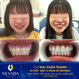 Hình ảnh bọc 14 răng sứ Zirconia của KH Mai Xuân Thanh – Ca 31