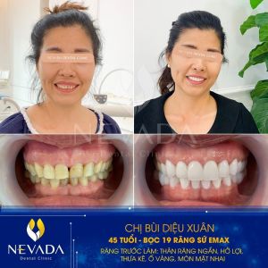 Hình ảnh bọc 19 răng sứ Emax của KH Bùi Diệu Xuân – Ca 32