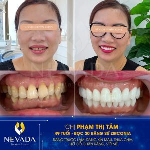 Hình ảnh bọc 20 răng sứ Zirconia của KH Phạm Thị Tâm – Ca 34