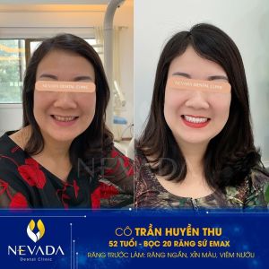 Hình ảnh bọc 20 răng sứ Emax của KH Trần Huyền Thu – Ca 35