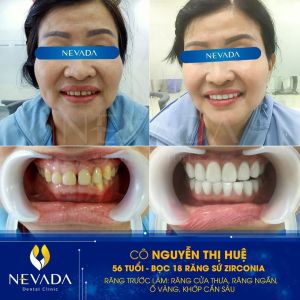 Hình ảnh bọc 18 răng sứ Zirconia của KH Nguyễn Thị Huệ - Ca 36