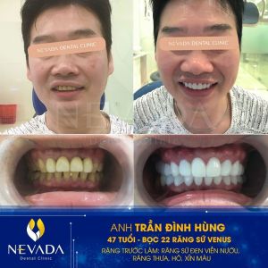 Hình ảnh bọc 22 răng sứ Venus của KH Trần Đình Hùng – Ca 38