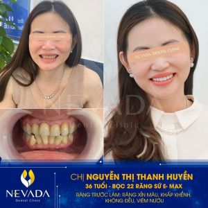 Hình ảnh bọc 22 răng sứ E-max của KH Nguyễn Thị Thanh Huyền – Ca 39