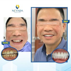 Hình ảnh bọc răng sứ cho khách hàng Vũ Trí Hòa - Ca 4