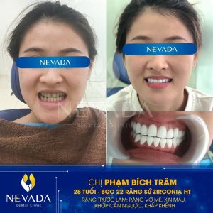 Hình ảnh bọc 22 răng sứ Zirconia HT của KH Phạm Bích Trâm – Ca 40