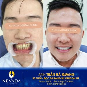 Hình ảnh bọc 20 răng sứ Cercon HT của KH Trần Bá Quang - Ca 42