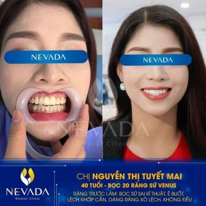 Hình ảnh bọc 20 răng sứ Venus của KH Nguyễn Thị Tuyết Mai – Ca 45