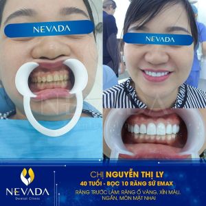 Hình ảnh bọc 10 răng sứ Emax của KH Nguyễn Thị Ly – Ca 46
