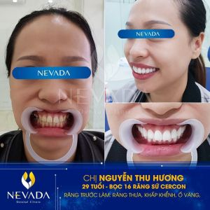 Hình ảnh bọc răng sứ của KH Nguyễn Thu Hương – Ca 47
