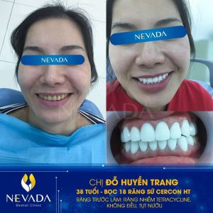 Hình ảnh bọc 18 răng sứ Cercon HT của KH Đỗ Huyền Trang – Ca 49