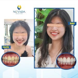 Hình ảnh bọc răng sứ cho khách hàng Minh Phượng - Ca 5